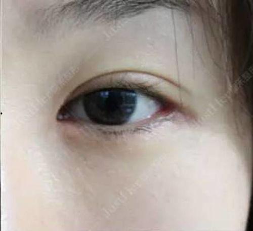 哪些女明星做过双眼皮